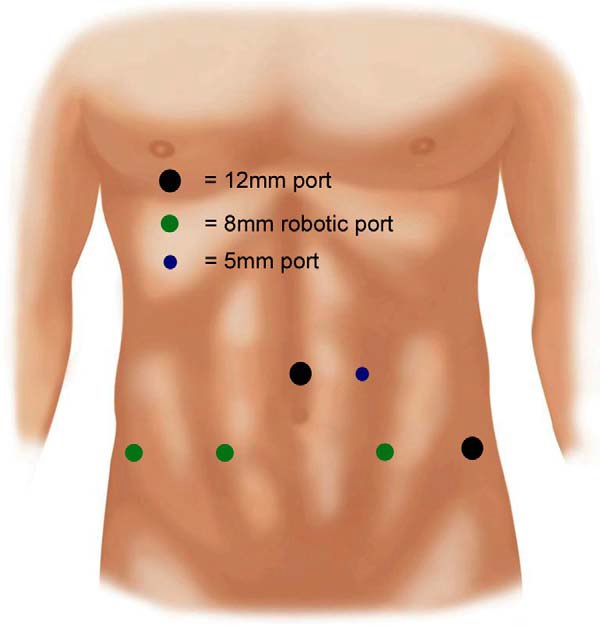 portais prostatectomia robótica