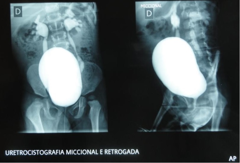 uretrocistografia miccional e retrc3b3grada1