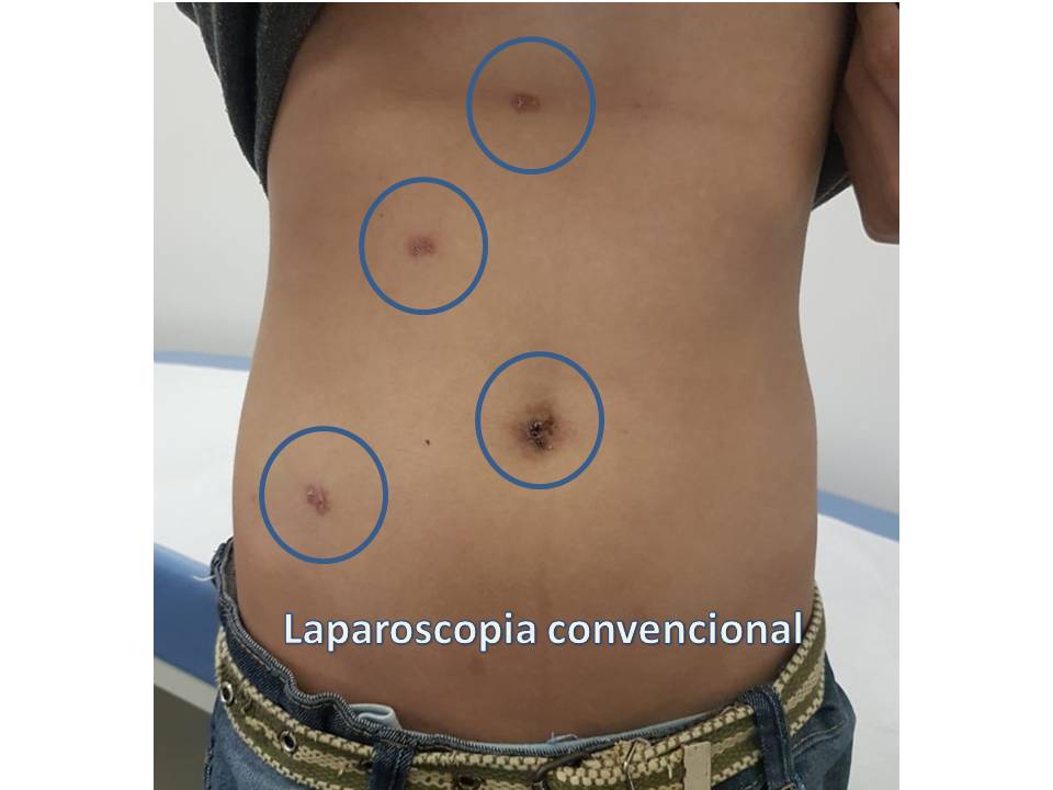 laparoscopia convencional