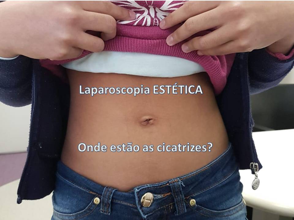 laparoscopia estetica1