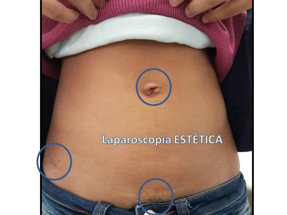 laparoscopia estetica 2
